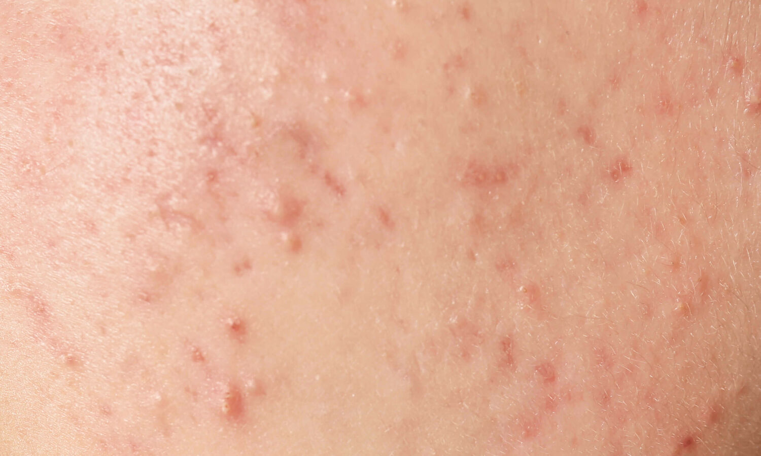 Blog 17 Huidtherapeut Groenlo YESS Huidtherapie acne volwassenen