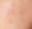 Blog 17 Huidtherapeut Groenlo YESS Huidtherapie acne volwassenen