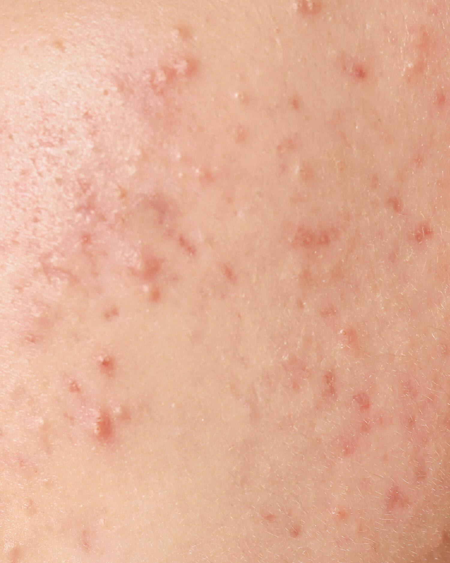 Blog 17 Huidtherapeut Groenlo YESS Huidtherapie acne volwassenen