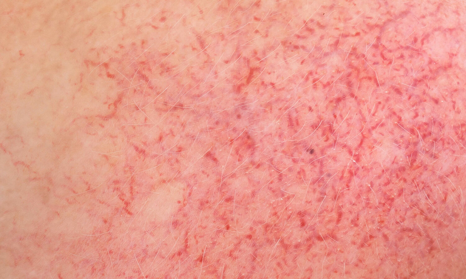 Blog 26 Huidtherapeut Groenlo YESS Huidtherapie rode huid