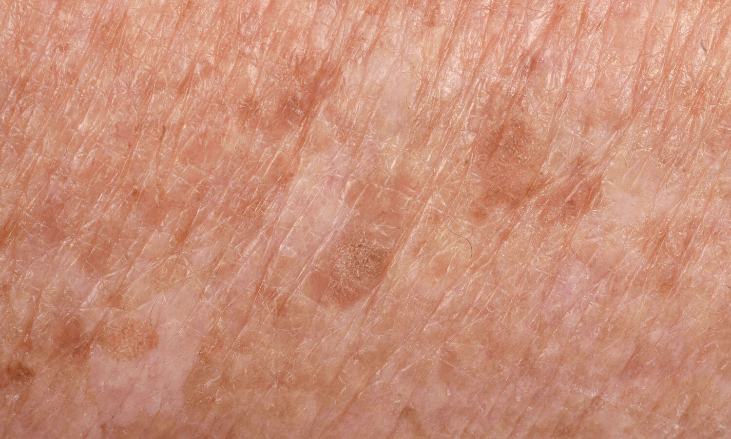 Blog 25 huidverbetering