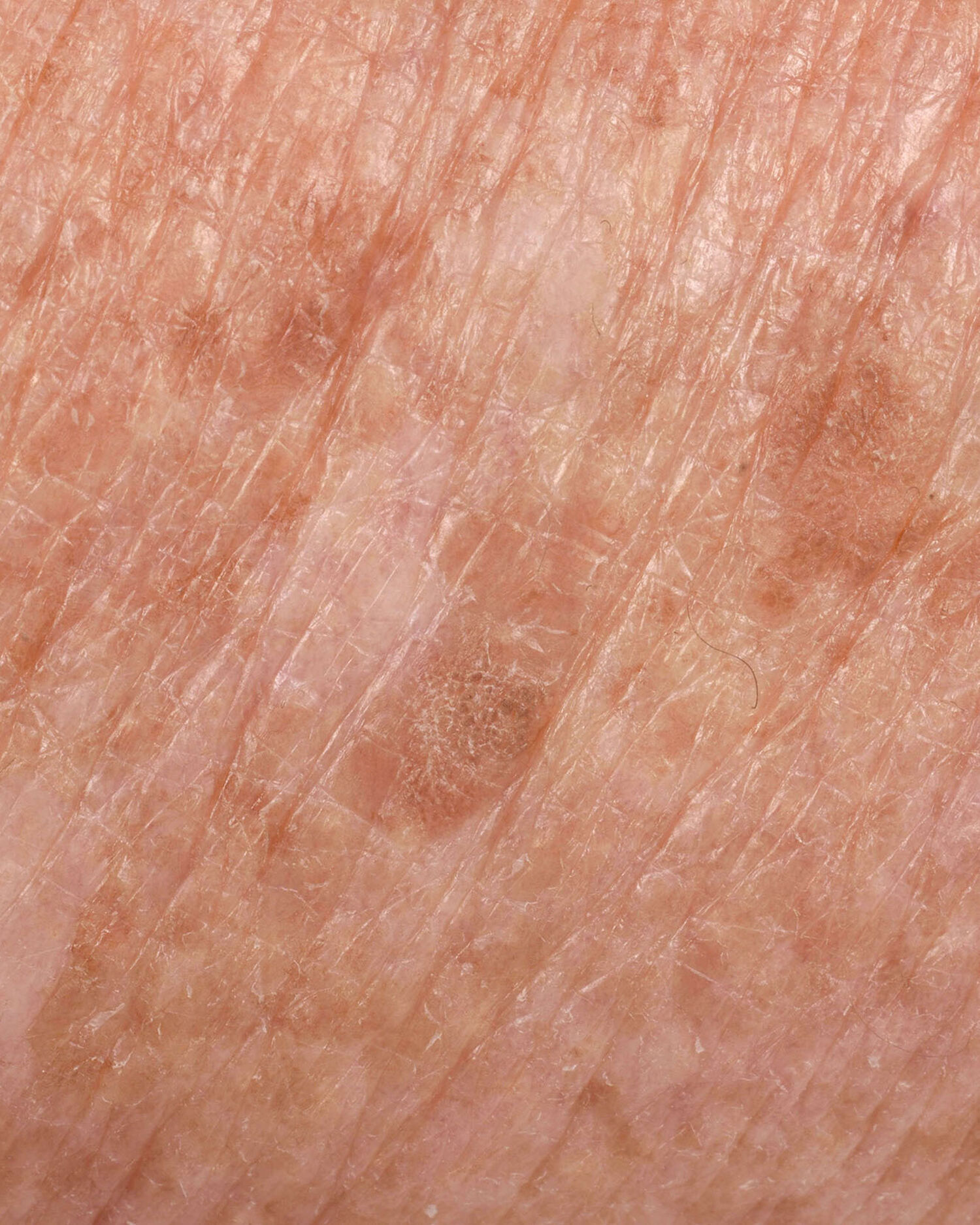 Blog 25 huidverbetering