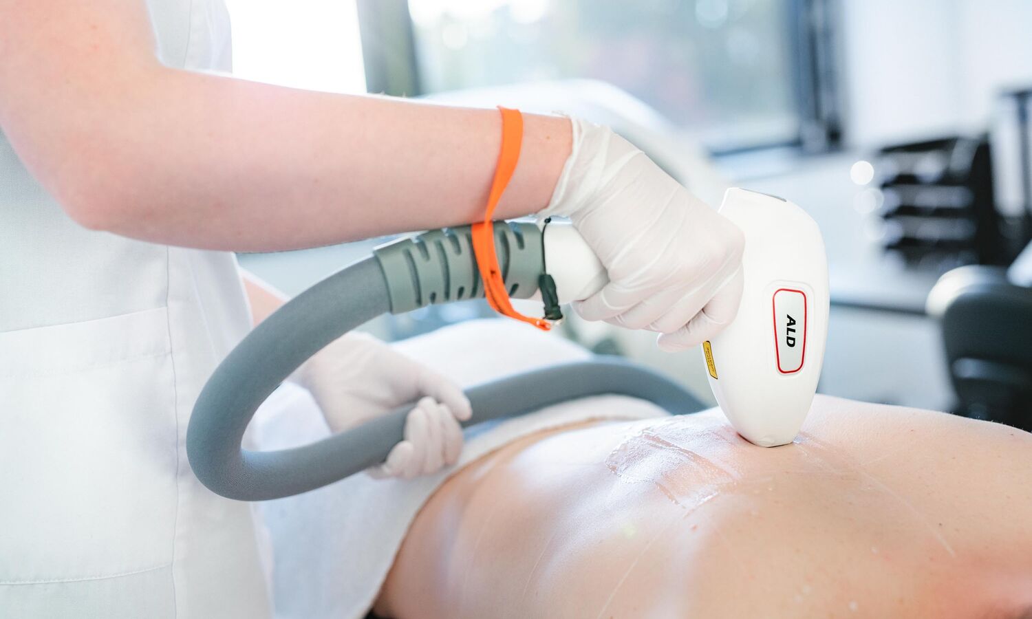 Blog 27 laserontharing zomer