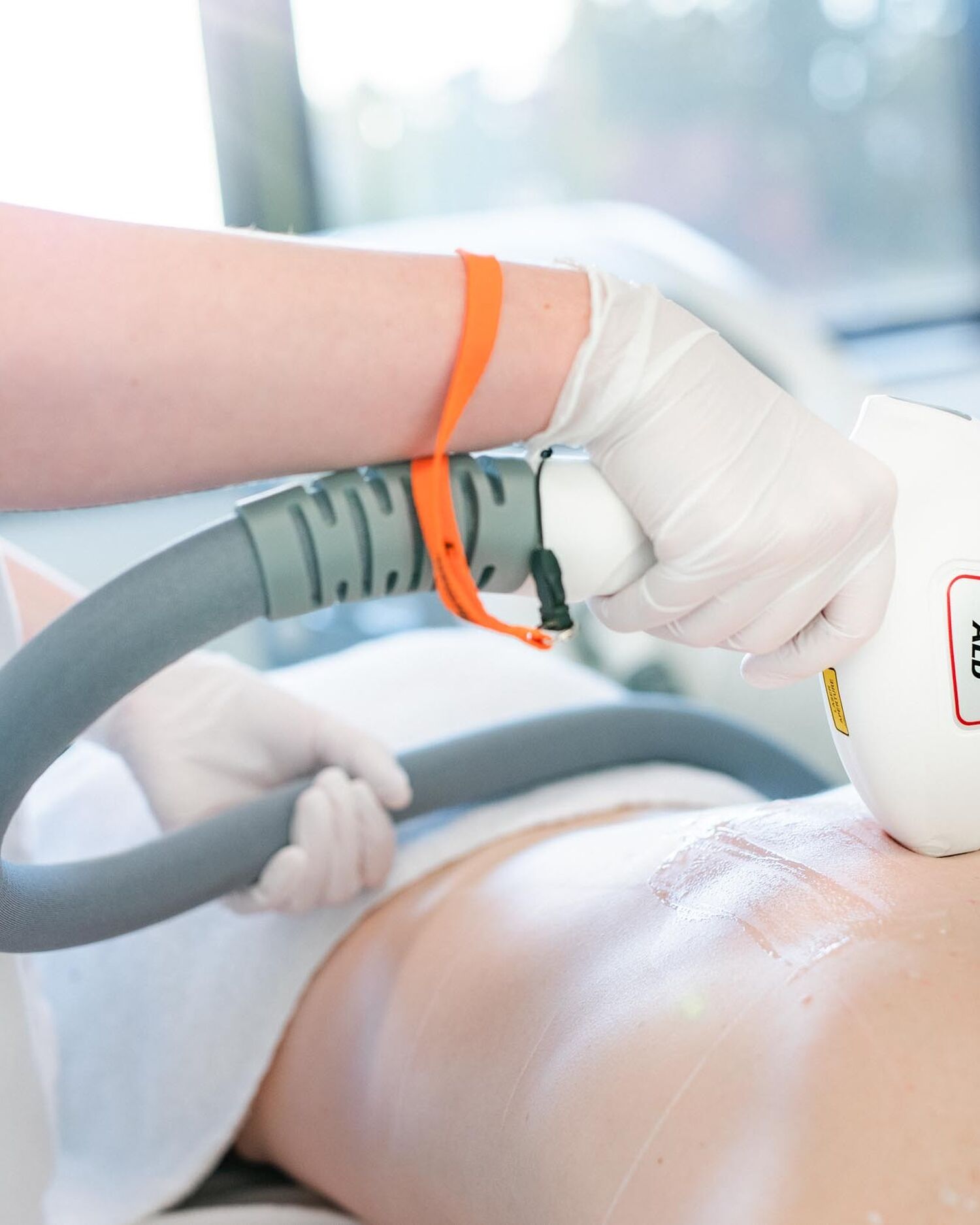 Blog 27 laserontharing zomer