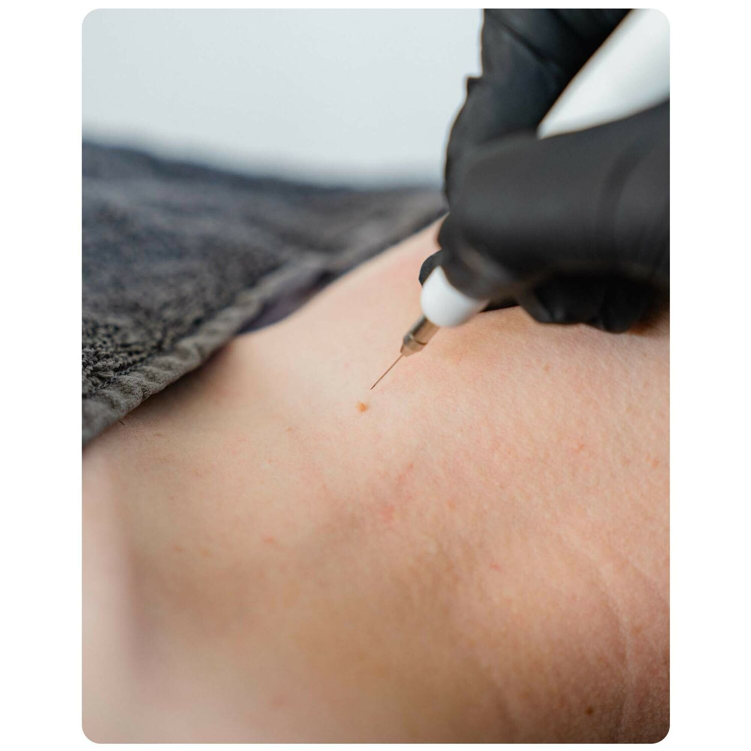 Huidtherapie Groenlo YESS 11