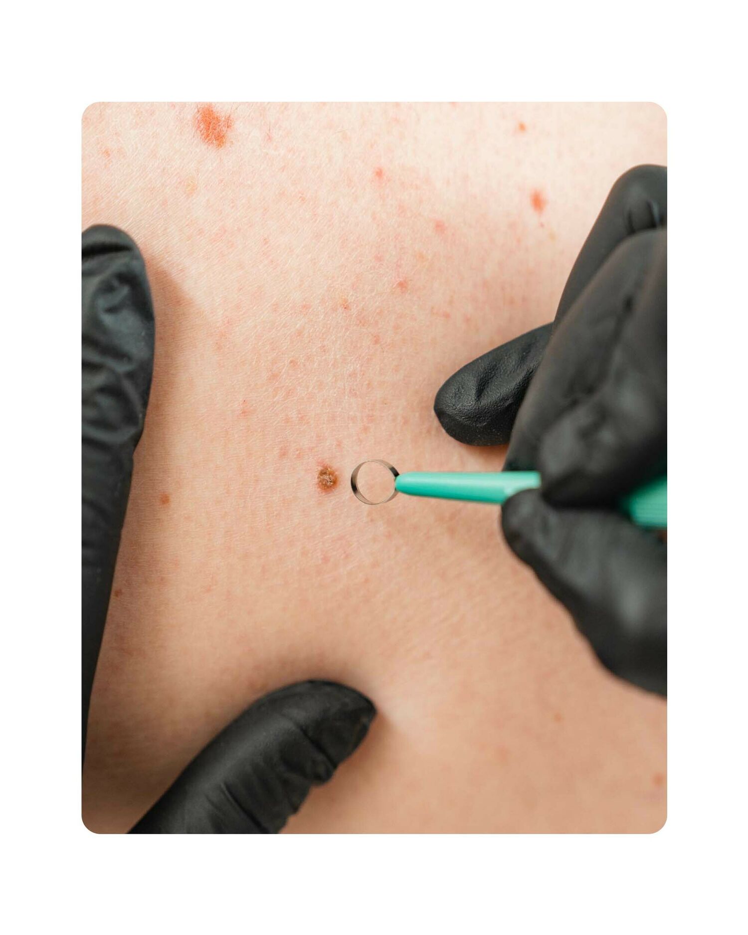 Huidtherapie Groenlo YESS 12