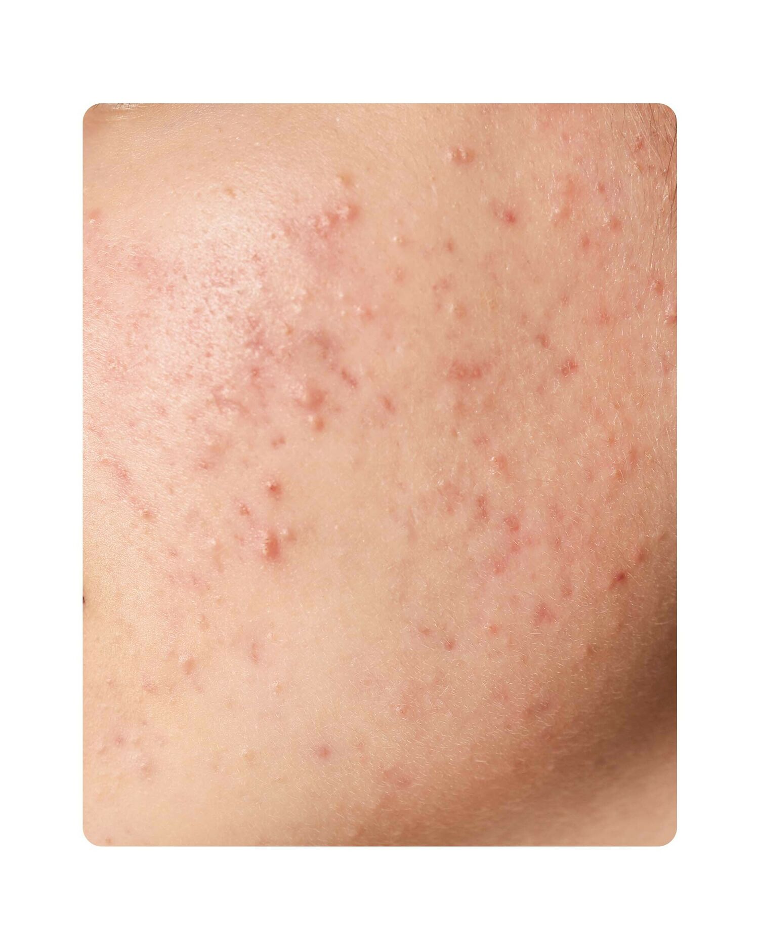 Huidtherapeut Groenlo Huidprobleem Acne 27jpg