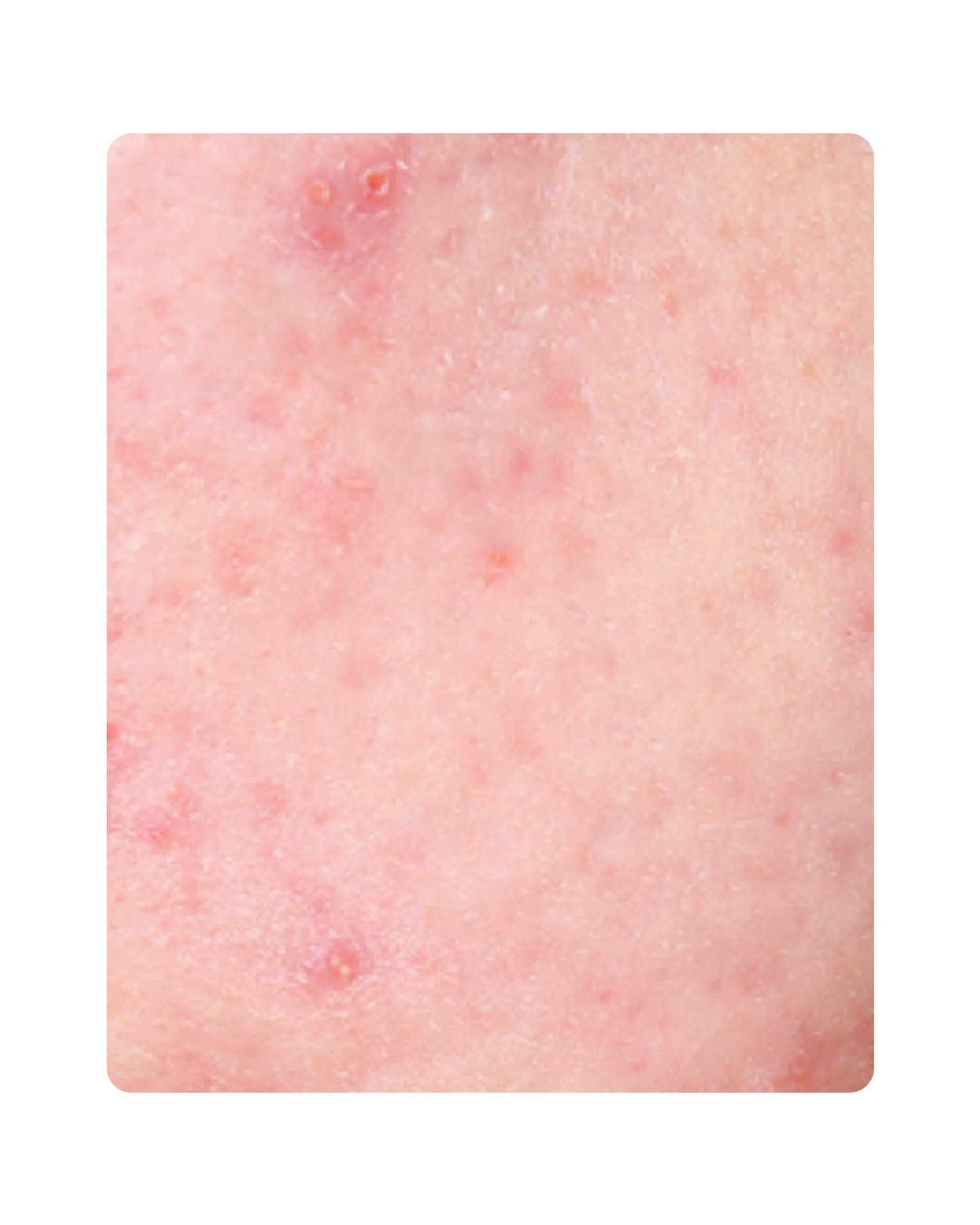 Huidtherapeut Groenlo Huidprobleem 28