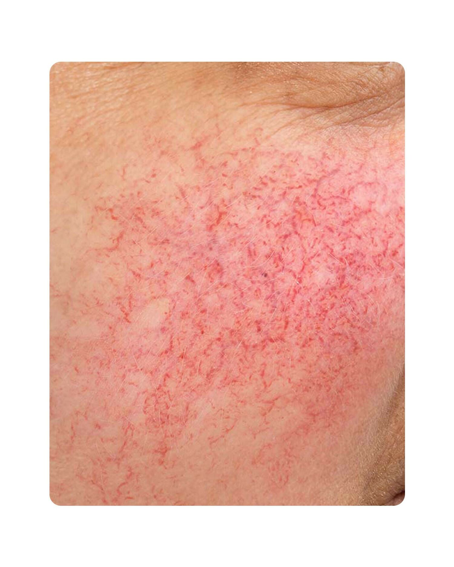 Huidtherpie Groenlo Huidprobleem couperose