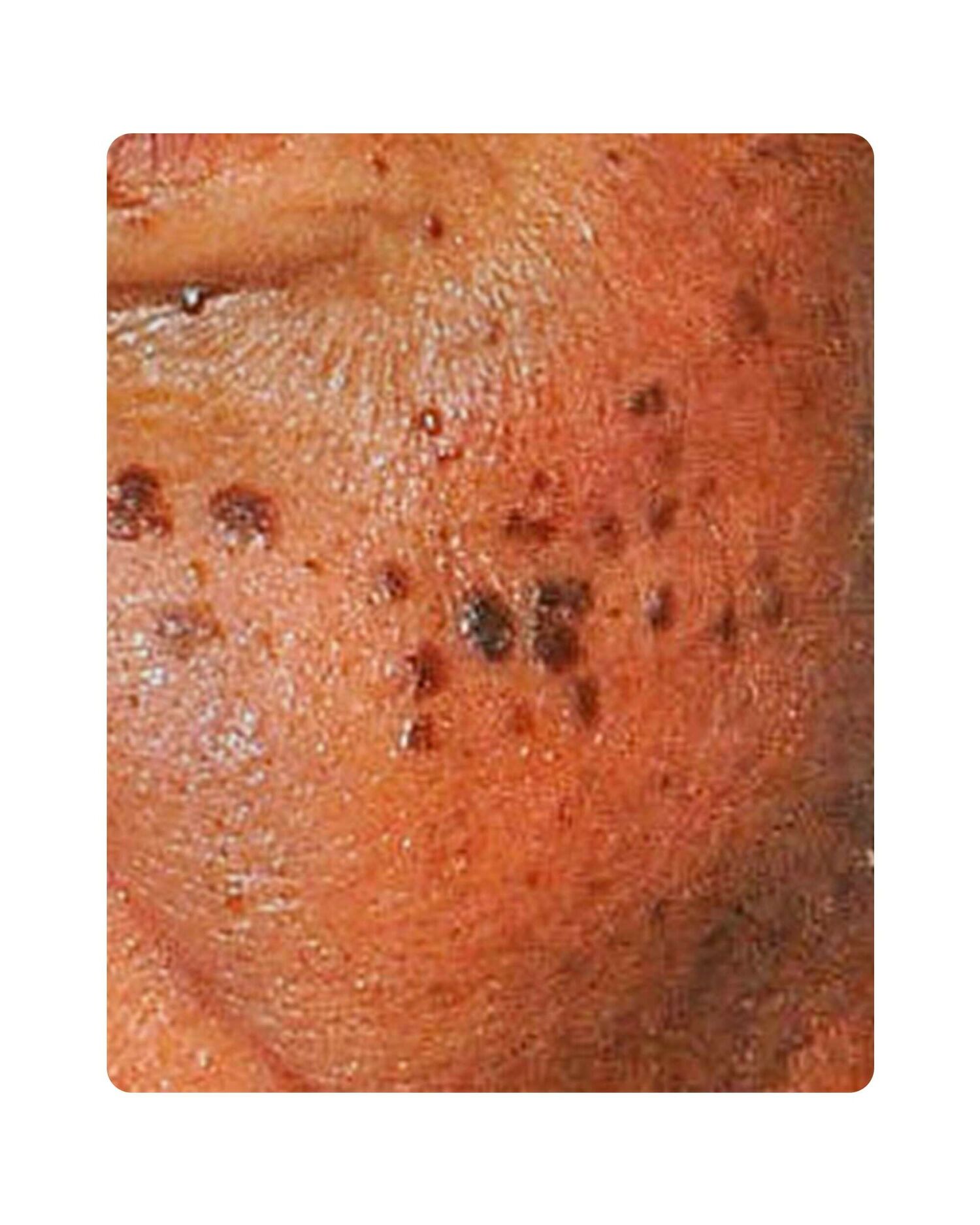 Huidtherpie Groenlo Huidprobleem dermatosis papulosa nigra