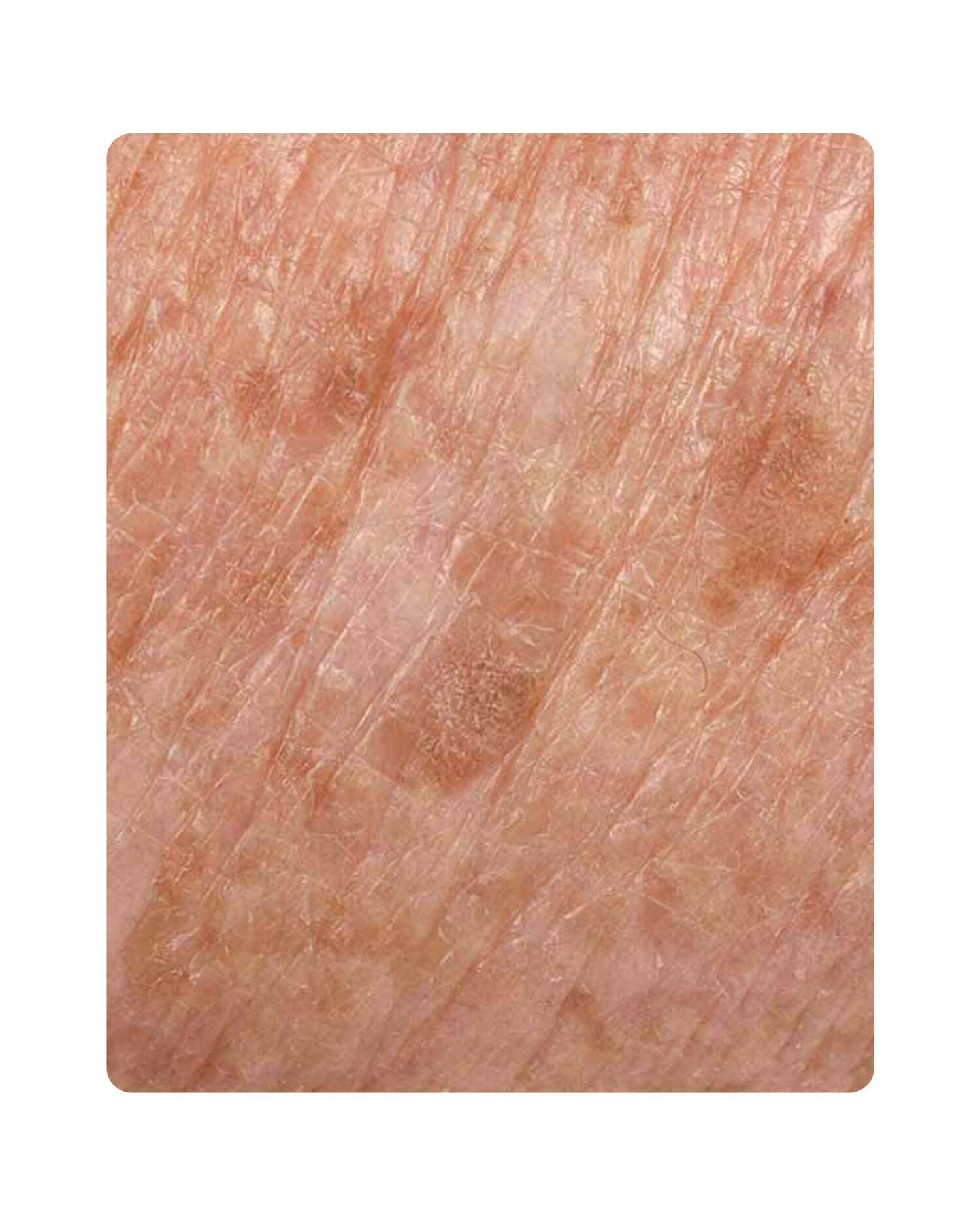 Huidtherpie Groenlo Huidprobleem huidveroudering