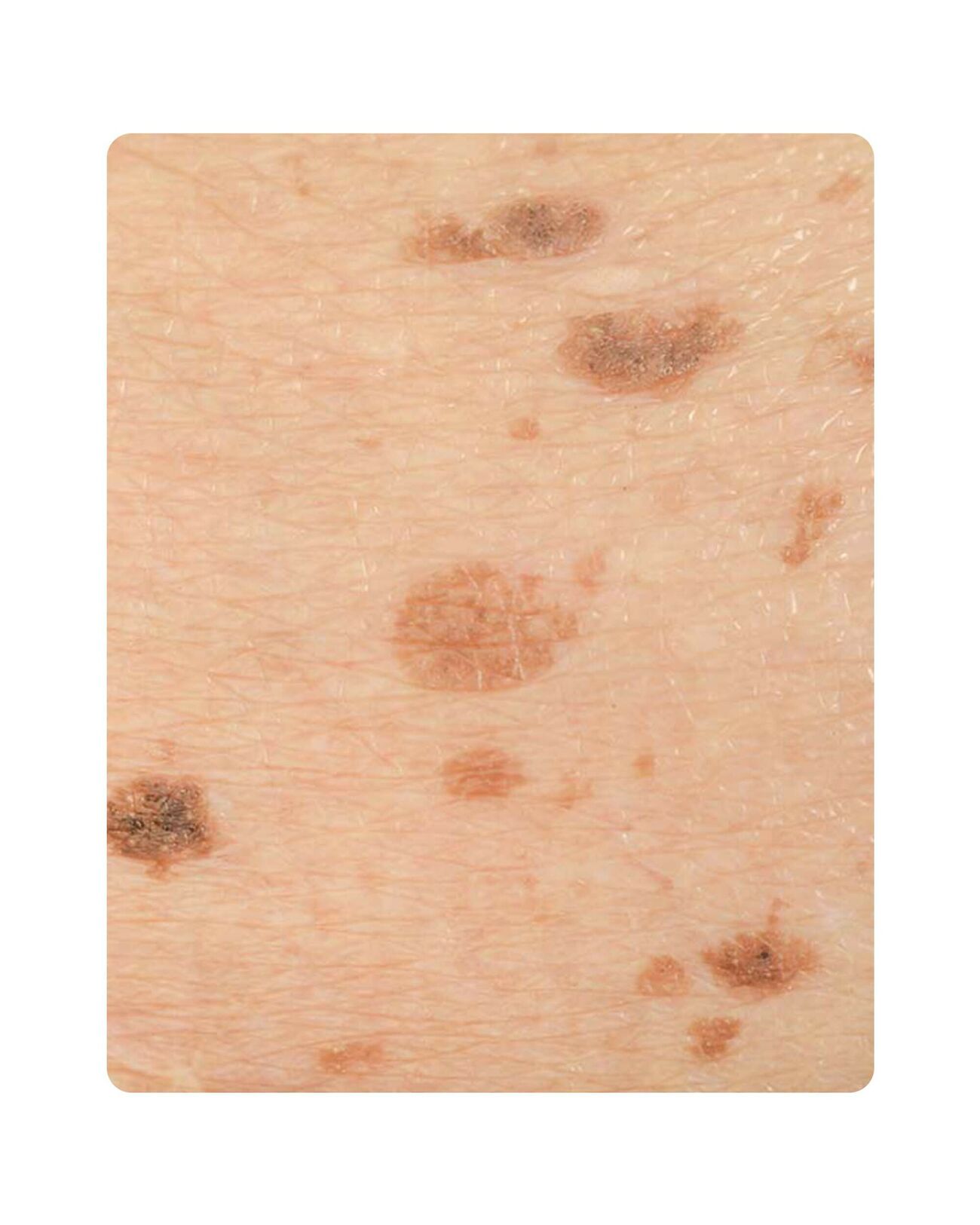 Lentigo Solaris YESS Huidtherapie lentigo-solaris-yess-huidtherapie