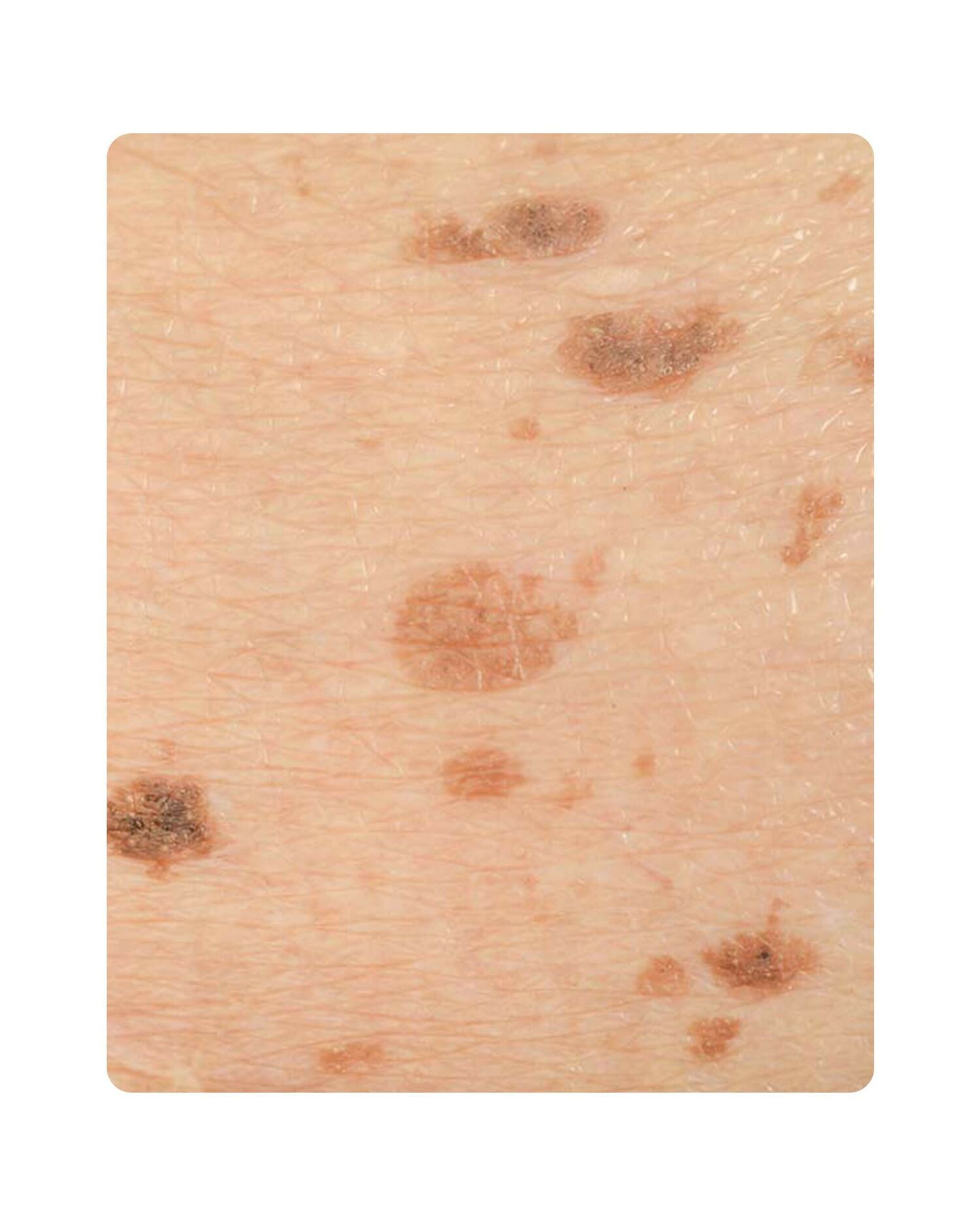 Huidtherpie Groenlo Huidprobleem lentigo solairs