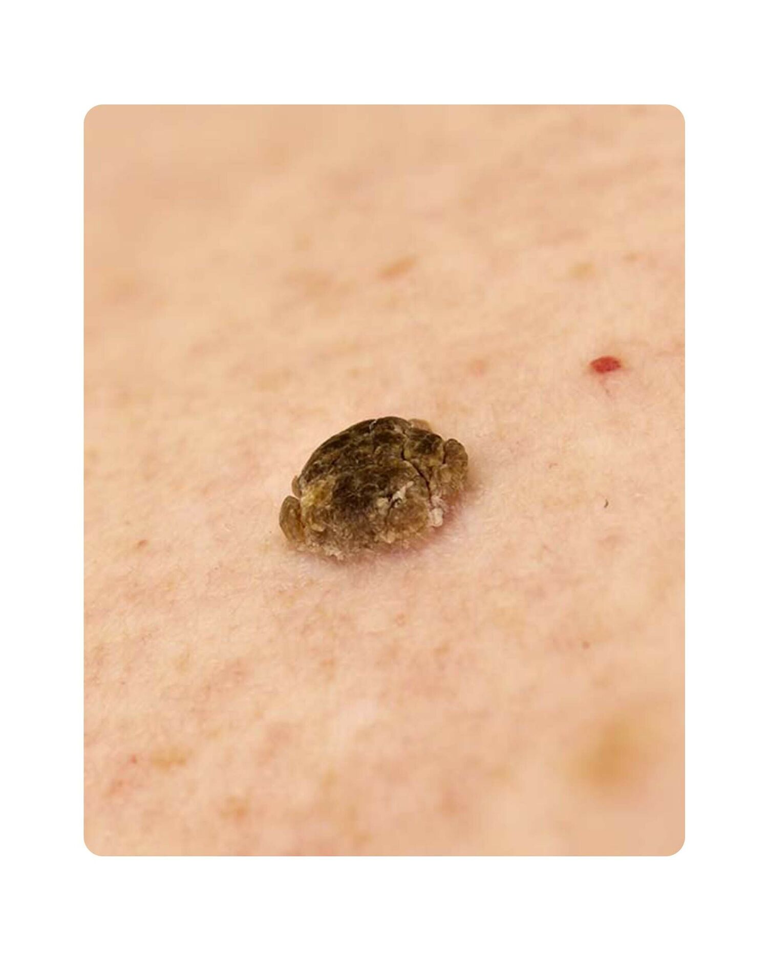 Huidtherpie Groenlo Huidprobleem ouderdomswrat