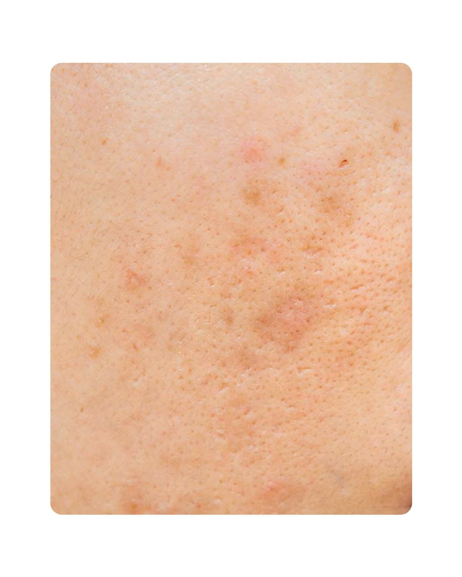 Huidtherpie Groenlo Huidprobleem pih