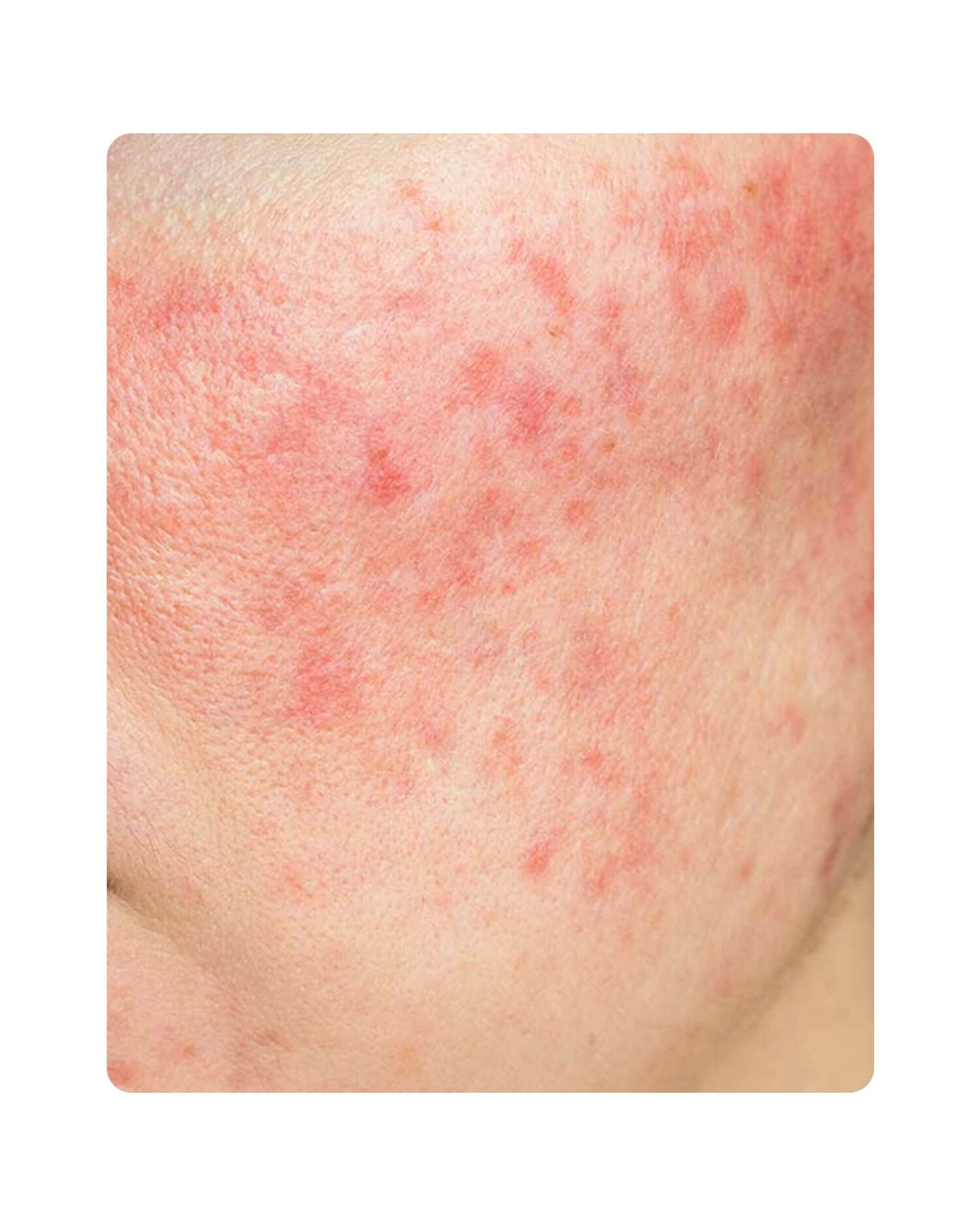 Huidtherpie Groenlo Huidprobleem rosacea