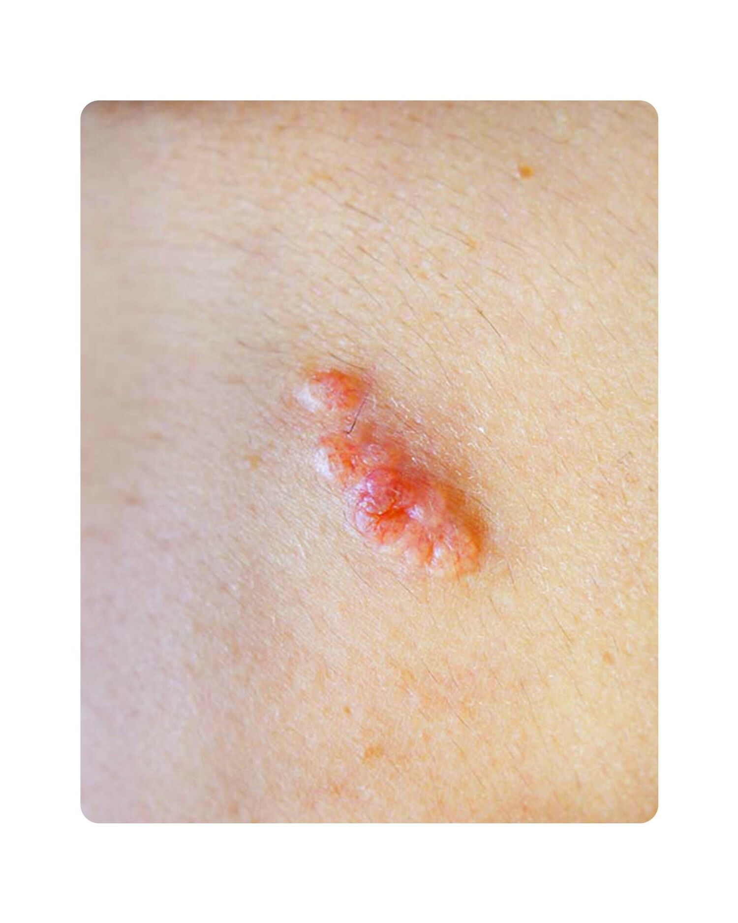 Huidtherpie Groenlo Huidprobleem talgklierhyperplasie