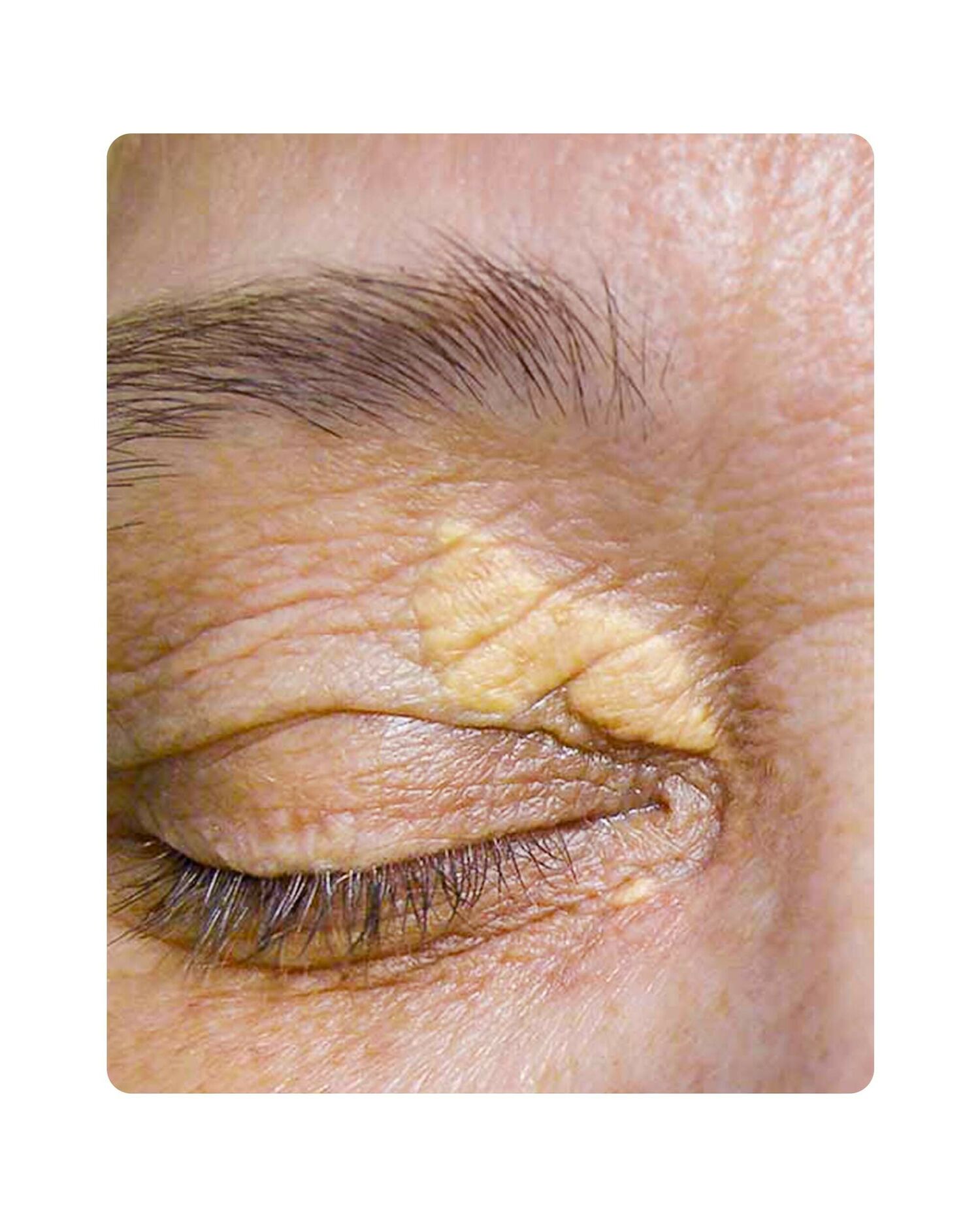 Huidtherpie Groenlo Huidprobleem xanthelasma