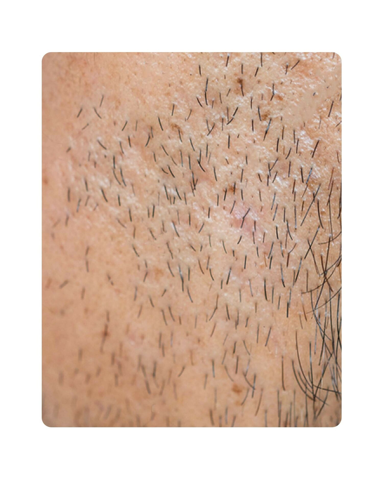 Huidtherpie Groenlo huidprobleem storende haargroei