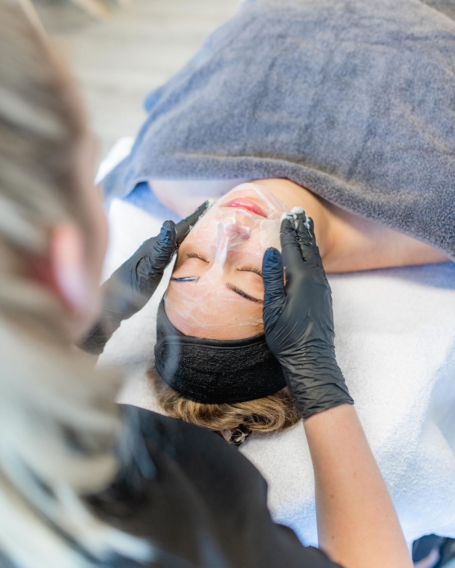 Acne behandeling Groenlo 02