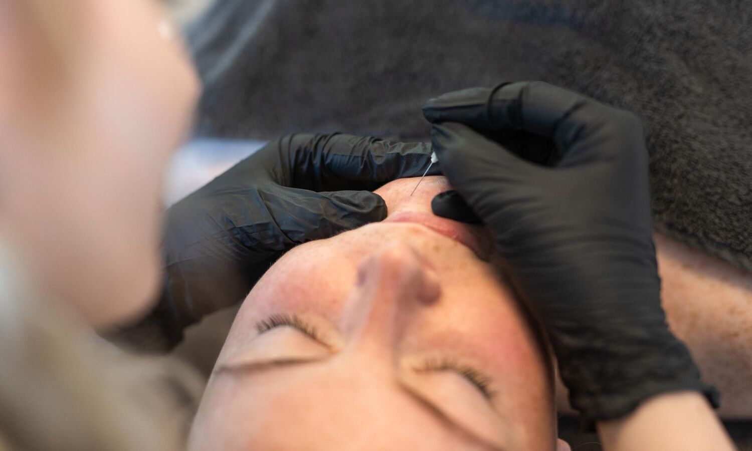 Acne behandeling Groenlo 05