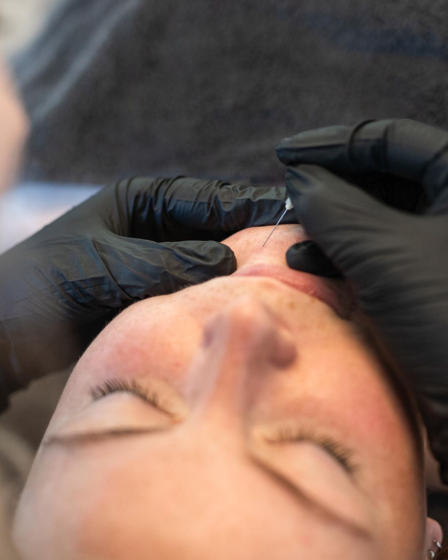 Acne behandeling Groenlo 05