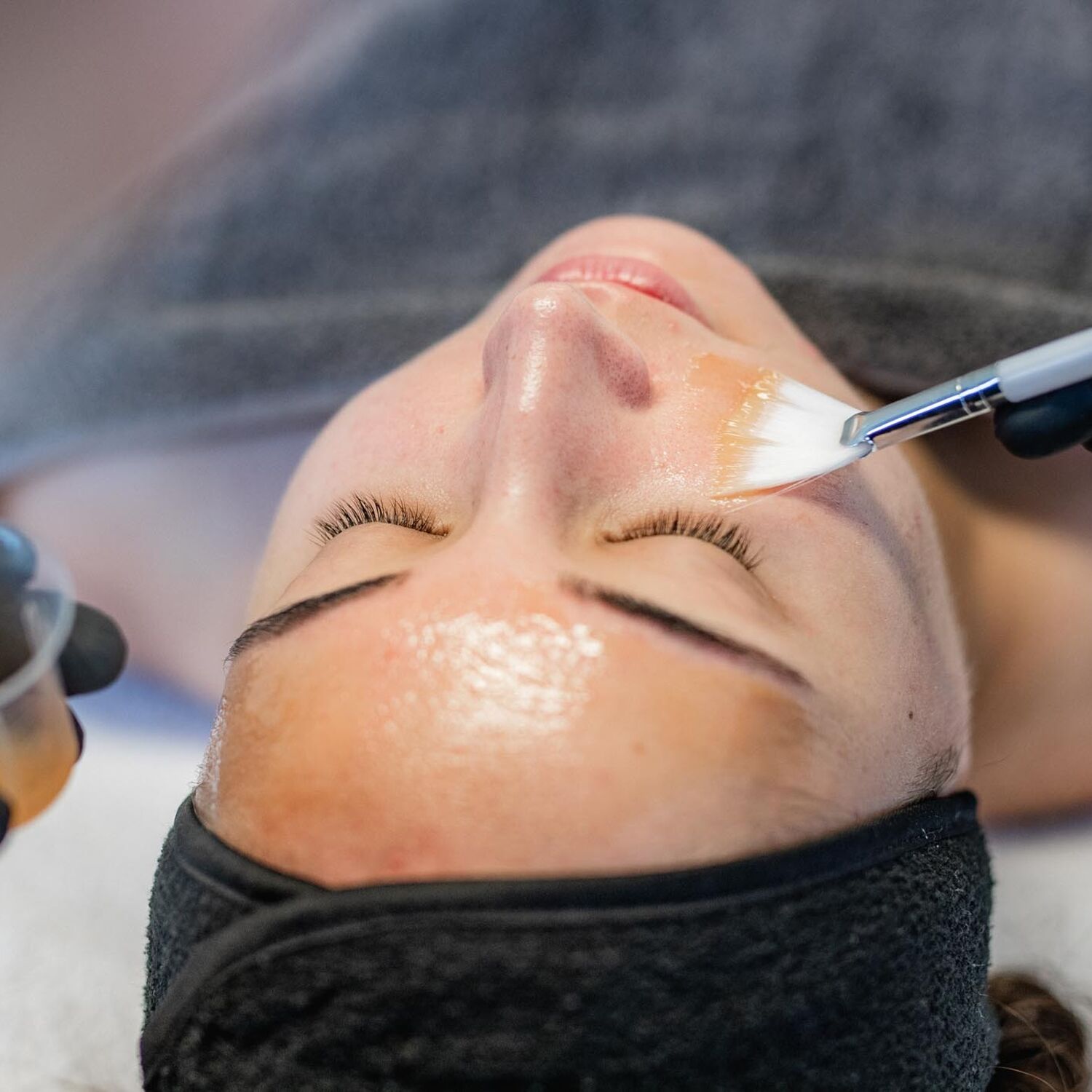 Chemische Peeling Acne Behandeling Groenlo 02