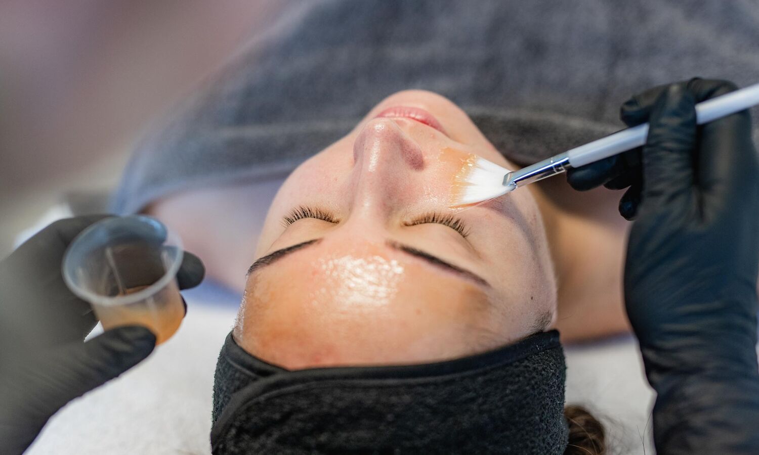 Chemische Peeling Acne Behandeling Groenlo 02