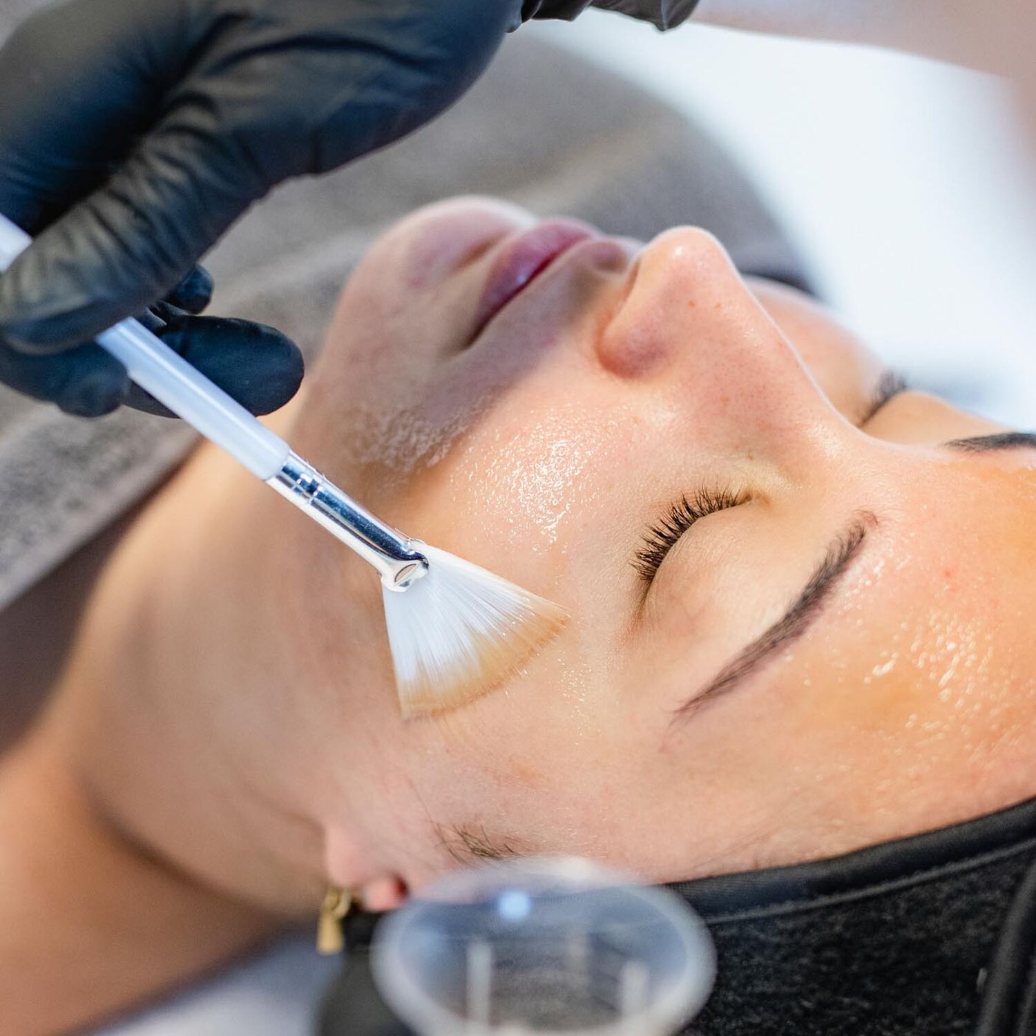 Chemische Peeling Acne Behandeling Groenlo 03