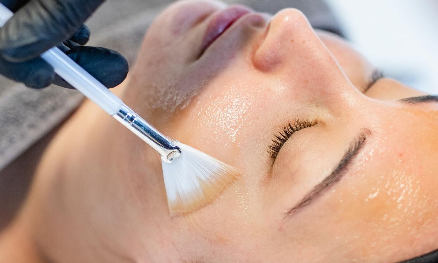 Chemische Peeling Acne Behandeling Groenlo 03