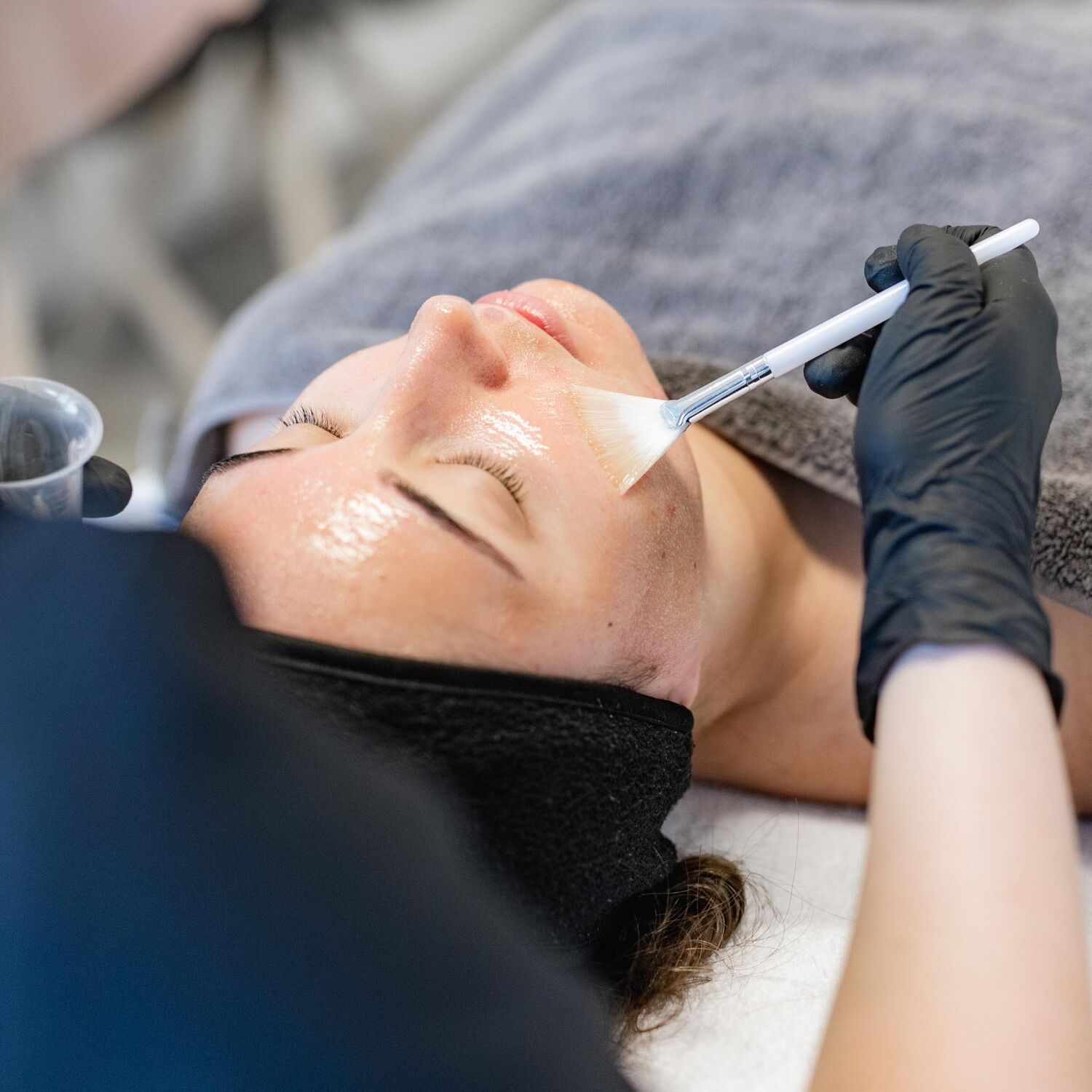 Chemische Peeling Acne Behandeling Groenlo 04