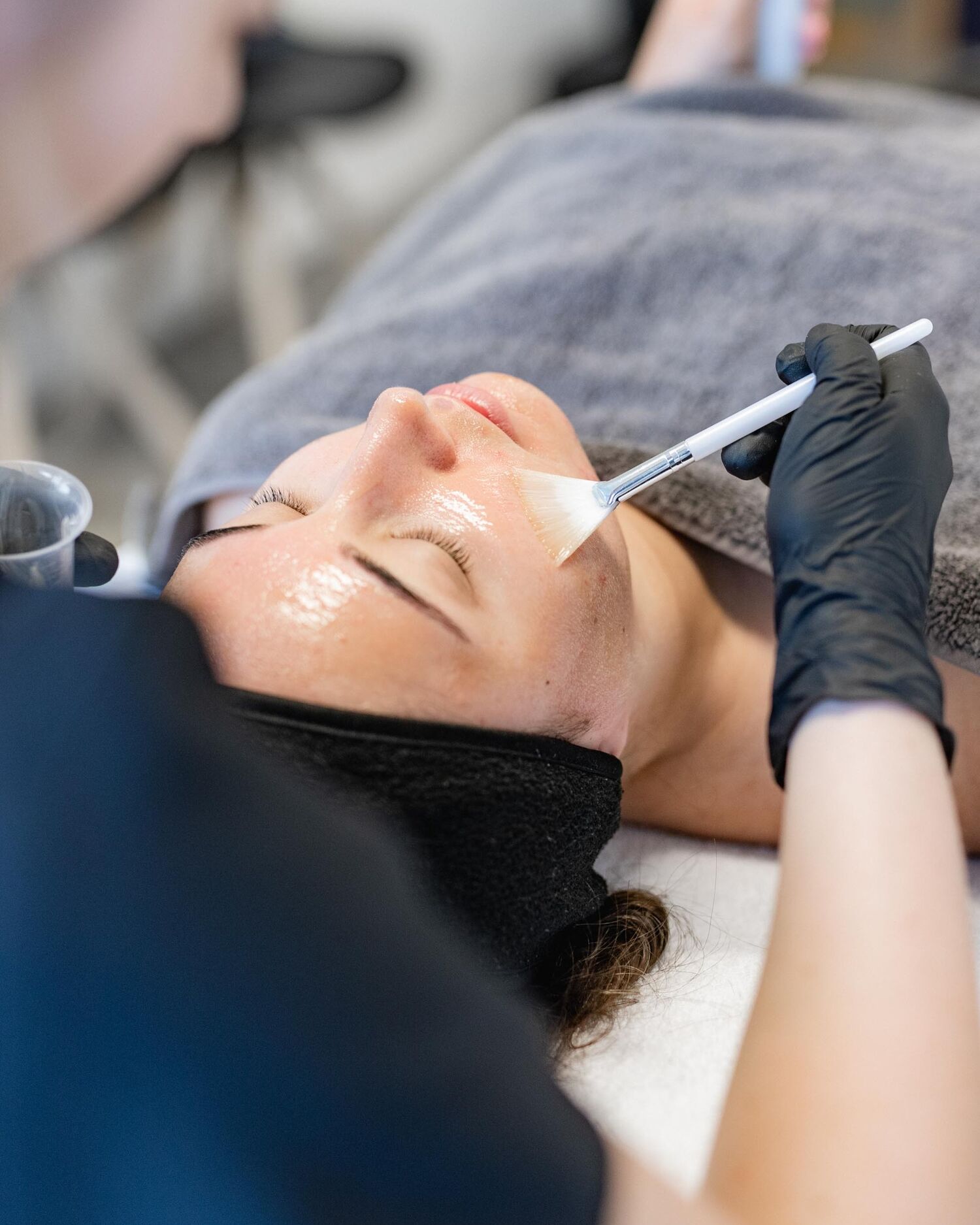 Chemische Peeling Acne Behandeling Groenlo 04