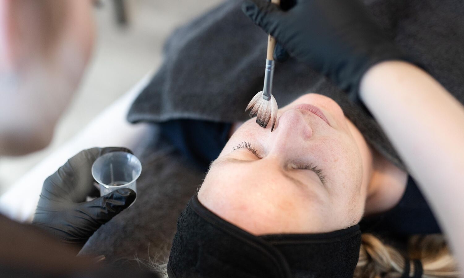 Chemische Peeling Acne Behandeling Groenlo 06