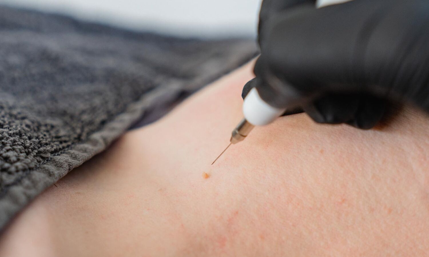 Huidonteffenheden Verwijderen Groenlo 01