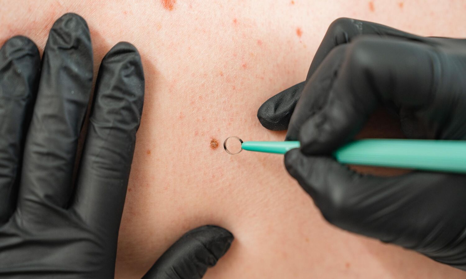 Huidonteffenheden Verwijderen Groenlo 02