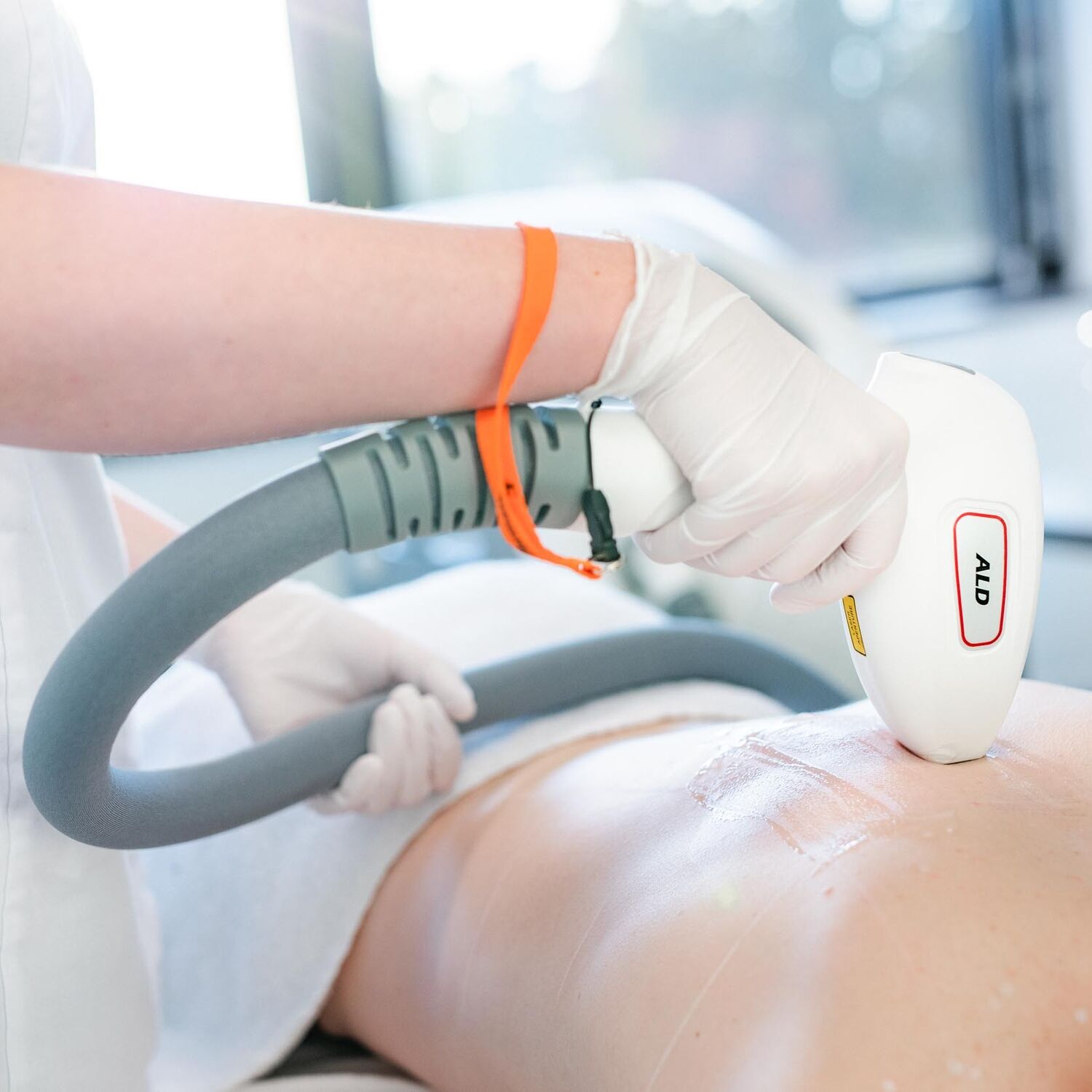 Laserontharing Groenlo 04