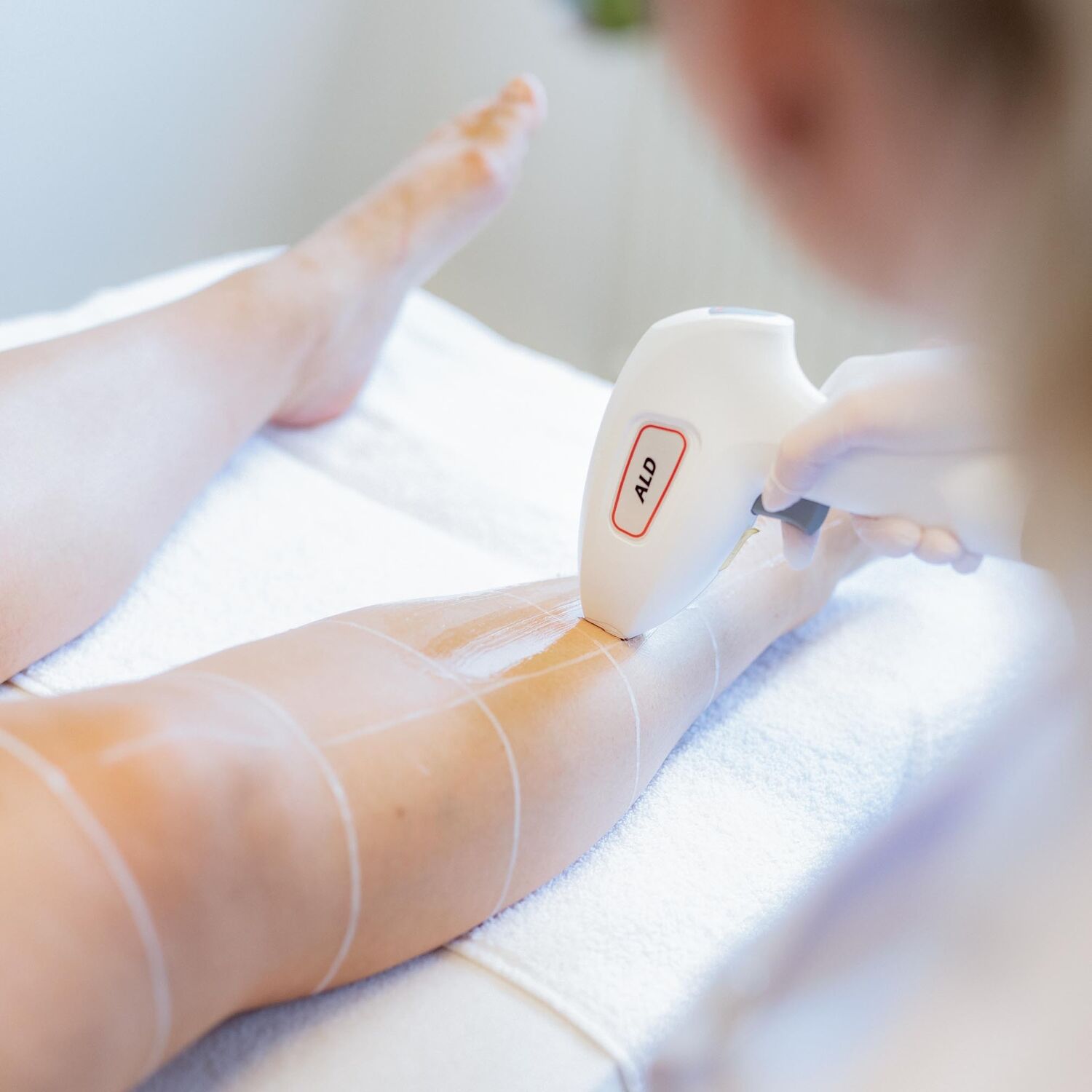 Laserontharing Groenlo 12