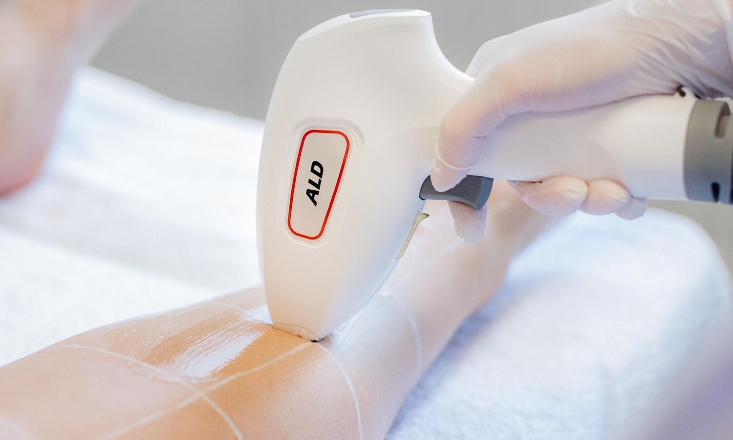 Laserontharing Groenlo 13