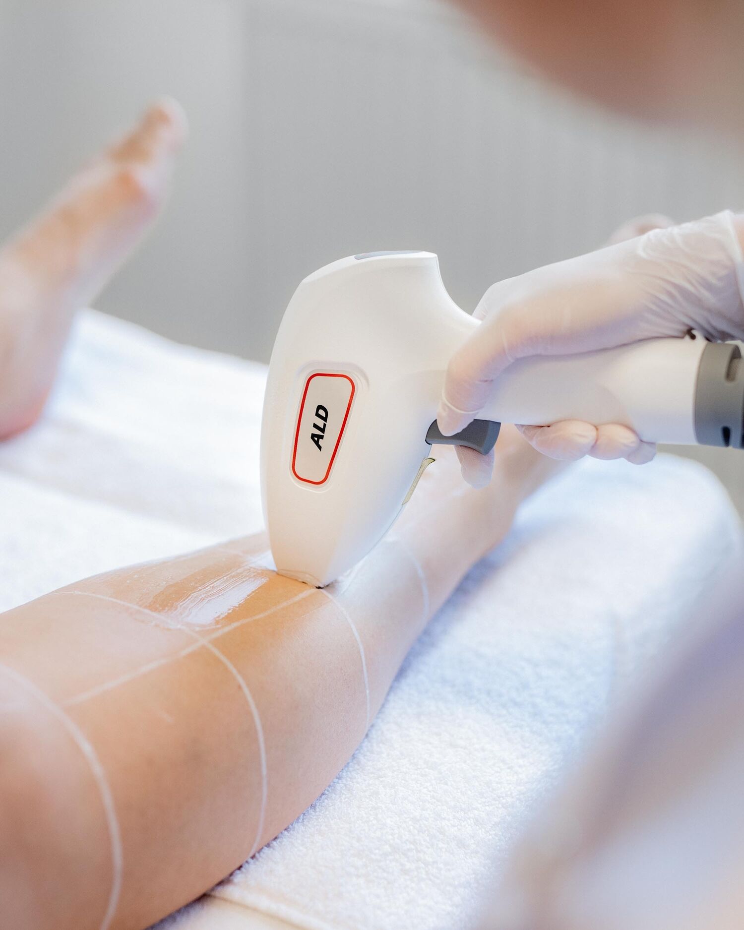 Laserontharing Groenlo 13