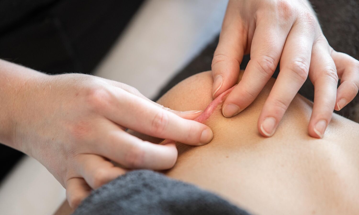 Littekentherapie Groenlo 01