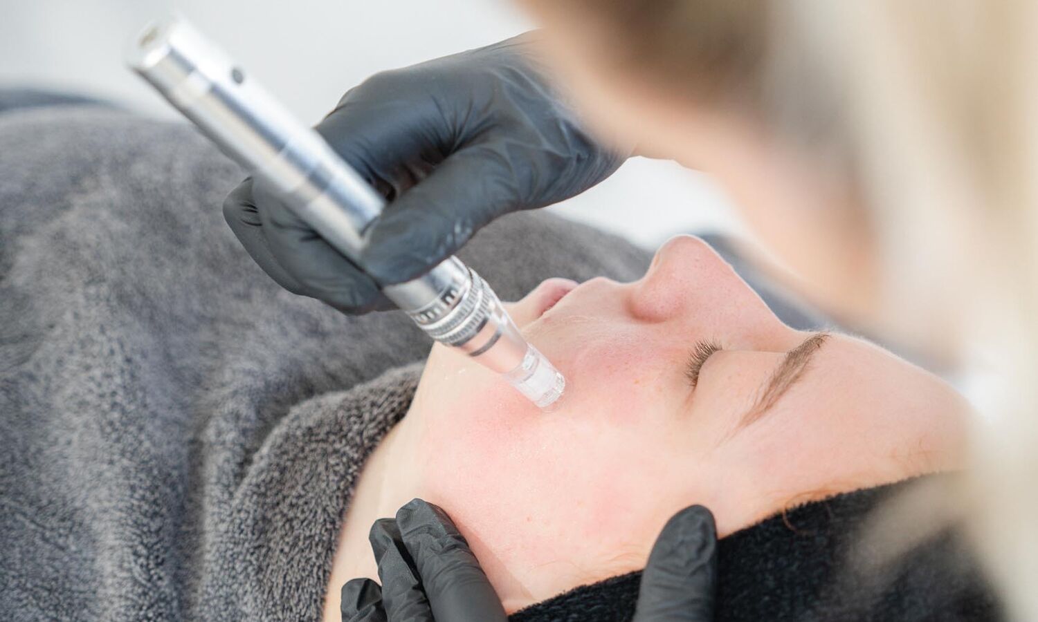 Microneedling Behandeling Groenlo 02