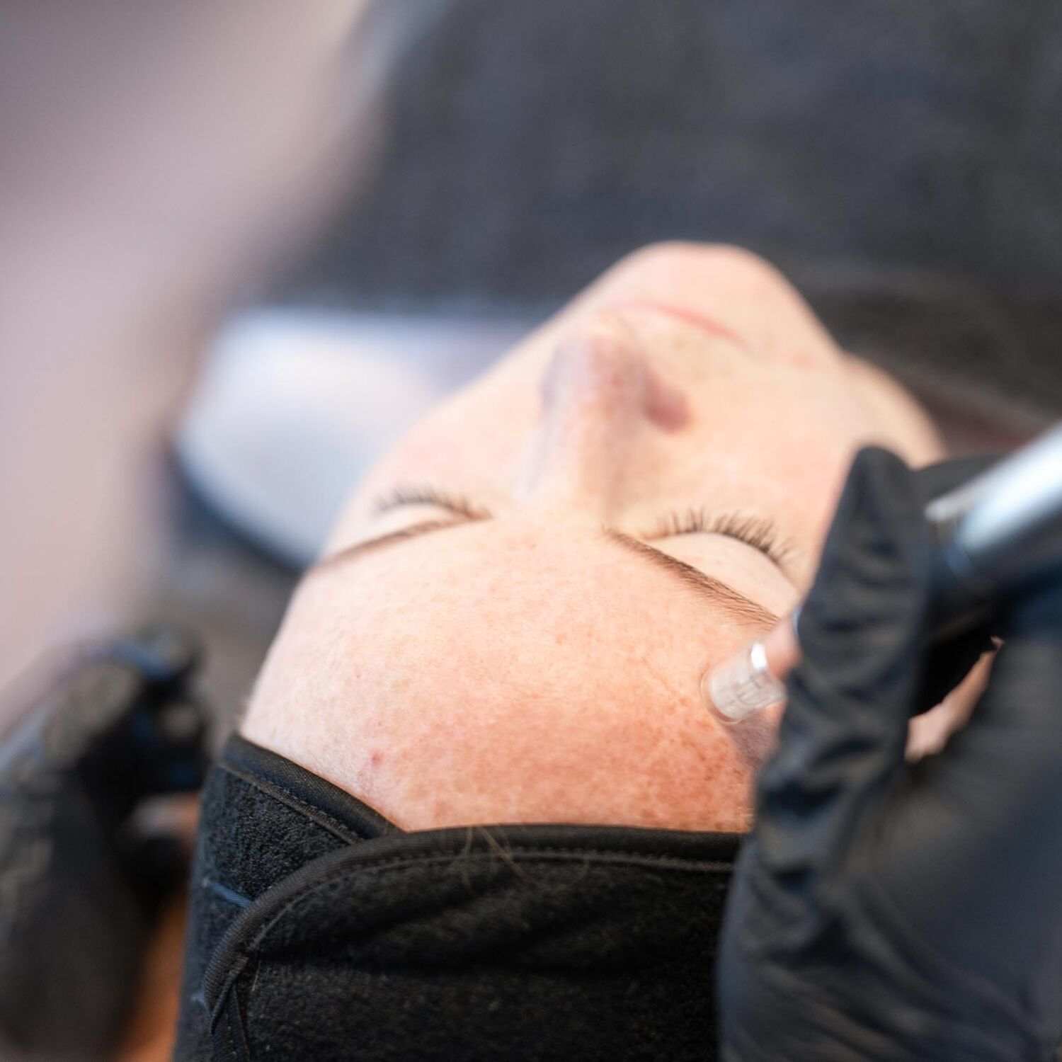 Microneedling Behandeling Groenlo 04