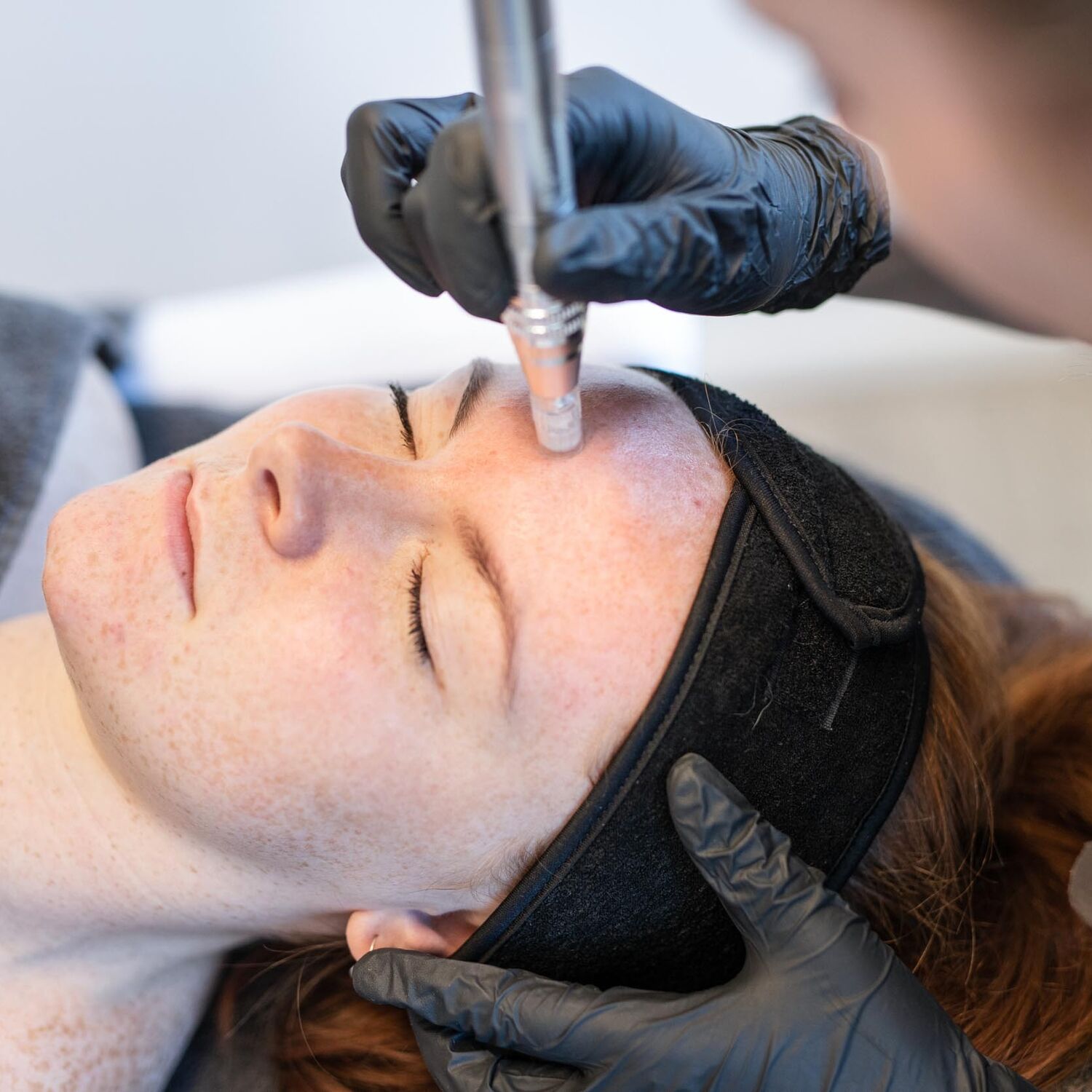 Microneedling Behandeling Groenlo 05