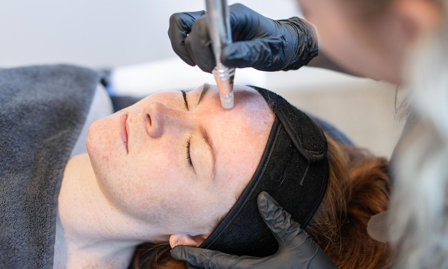 Microneedling Behandeling Groenlo 05