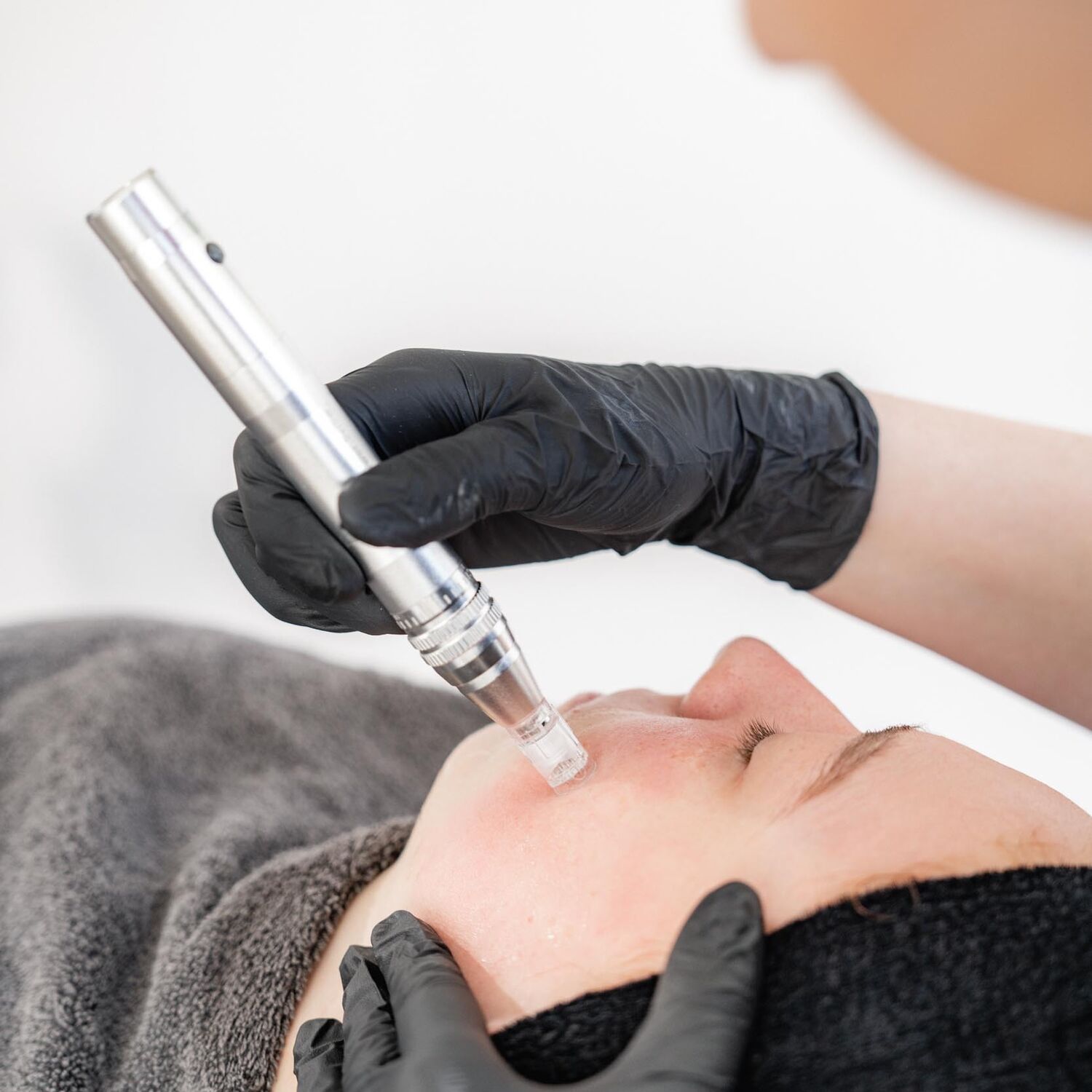 Microneedling Behandeling Groenlo 07