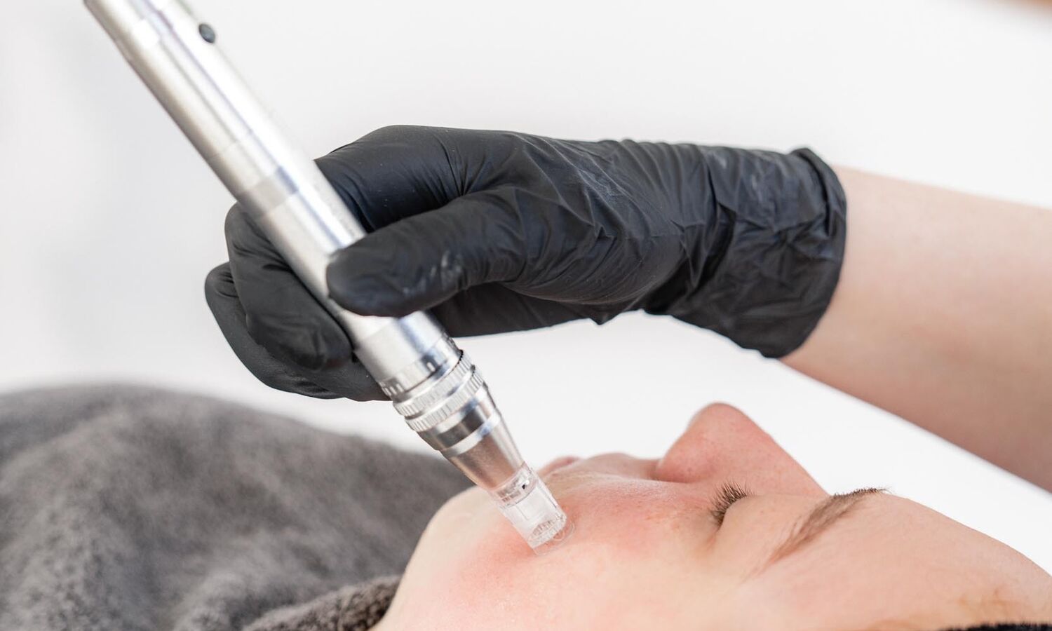 Microneedling Behandeling Groenlo 07