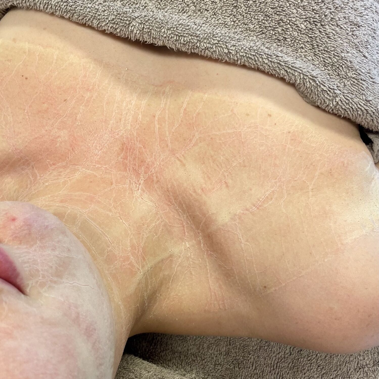 YES Slymfatischeterapie2