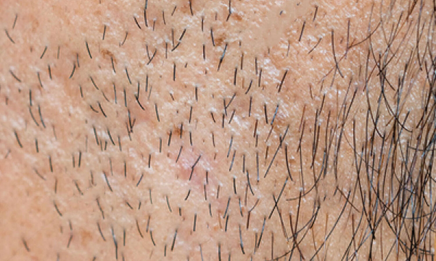 Huidtherapeut Groenlo Storende haargroei