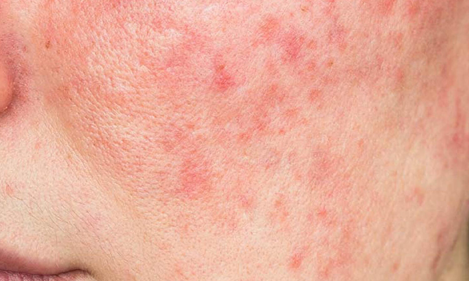 Huidtherapeut Groenlo Huidprobleem Roodheid