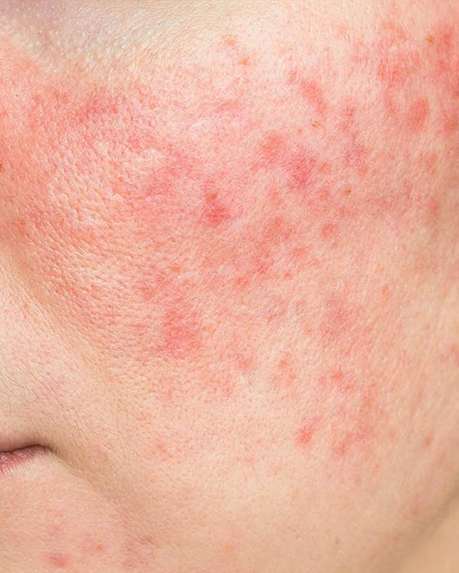 Huidtherapeut Groenlo Huidprobleem Roodheid